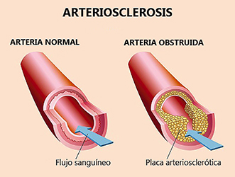 ﻿Los últimos descubrimientos ﻿sobre arterioesclerosis