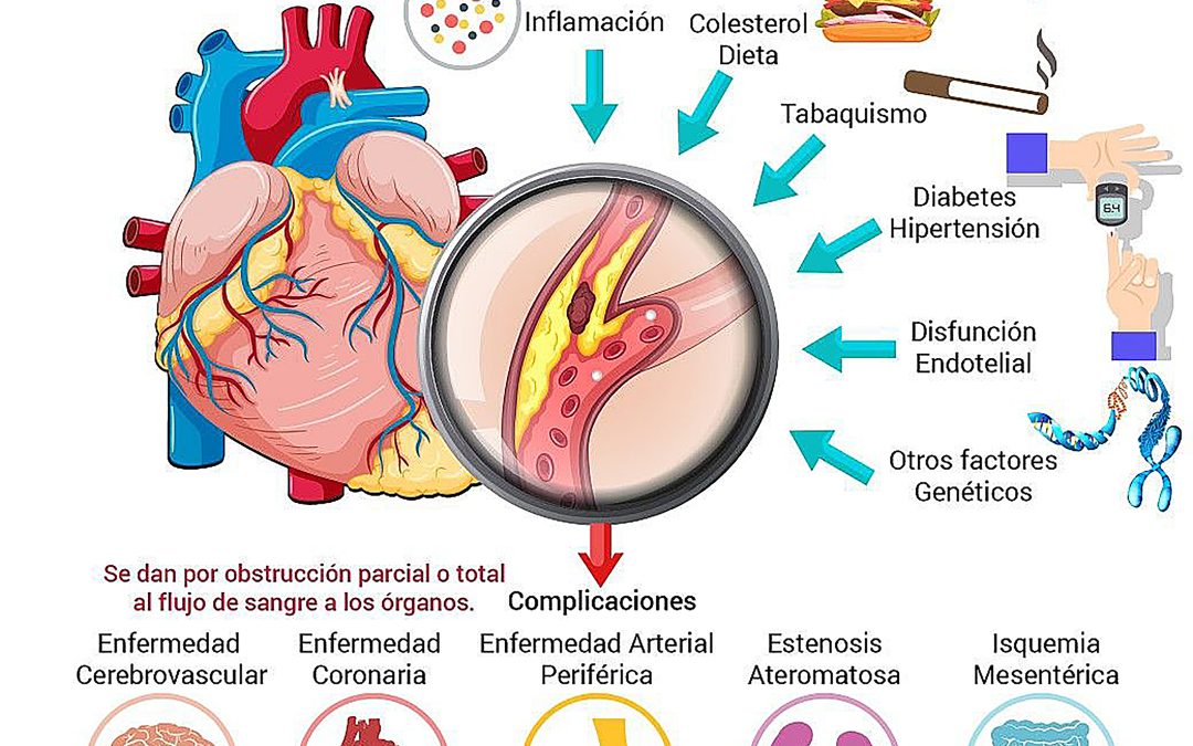 ﻿Los últimos descubrimientos ﻿sobre arterioesclerosis (Final)