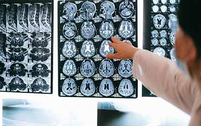 ﻿La vacuna para el Alzheimer podría estar en nuestro cerebro