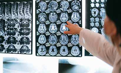 ﻿La vacuna para el Alzheimer podría estar en nuestro cerebro